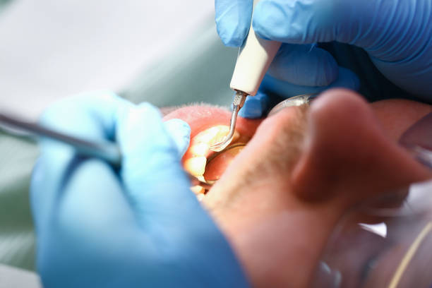 Best Emergency Treatment for Dental Infections or Abscesses in Blanco, TX