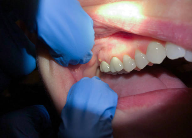 Best Emergency Gum Treatment in Blanco, TX